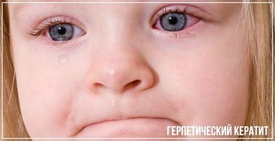 Девочка с герпетическим кератитом