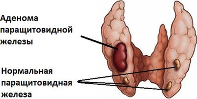 Аденома паращитовидной железы