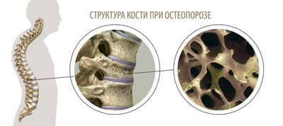 Кости при остеопорозе