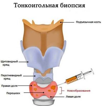 проведение тонкоигольной биопсии