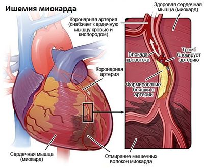 ишемия миокарда