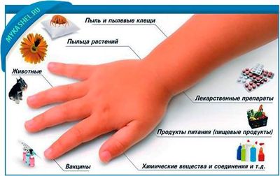 аллергический кашель у ребенка