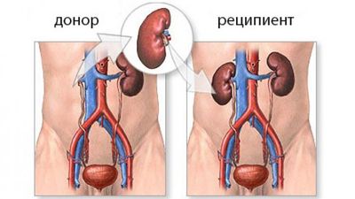 Трансплантация почки