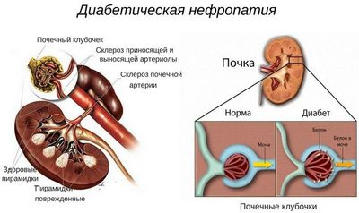 диабетическая нефропатия