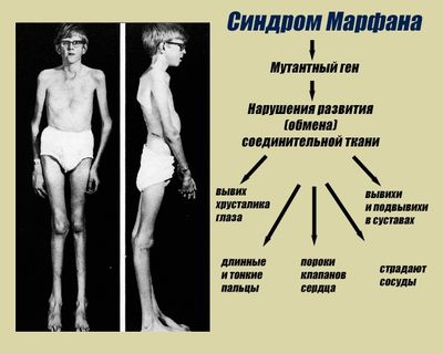 Синдром Марфана