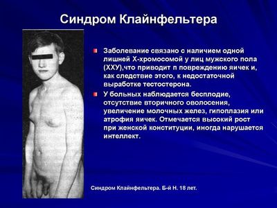 Кляйнфельтера