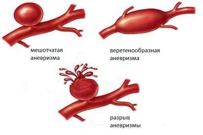 виды аневризмы
