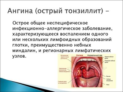 лечение ангины