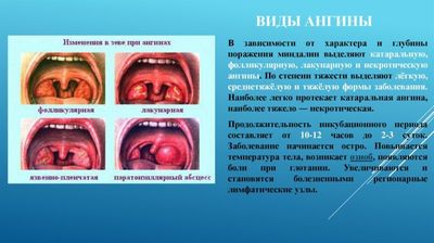 виды ангины