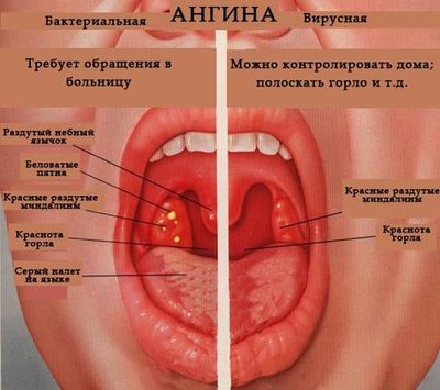 Антибиотики при ангине у ребенка