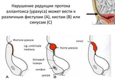 Аномалии урахуса