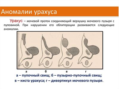 аномалии урахуса
