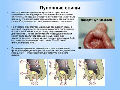 пупочные свищи