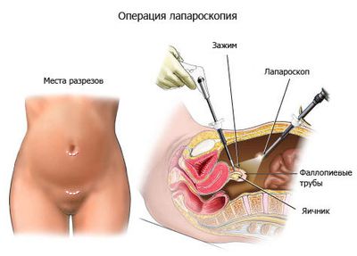 лапароскопия
