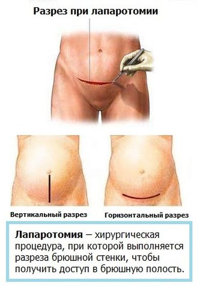 лапаротомия