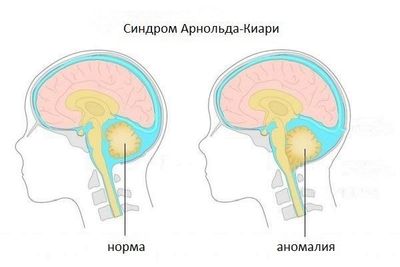 аномалия арнольда киари