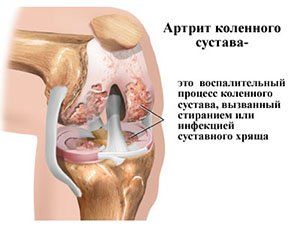 Лечение детского артрита коленного сустава