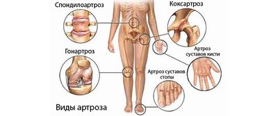 Виды артрозов