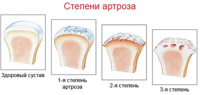 Степени артроза