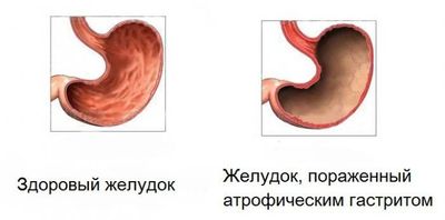 здоровый и пораженный атрофическим гастритом желудок