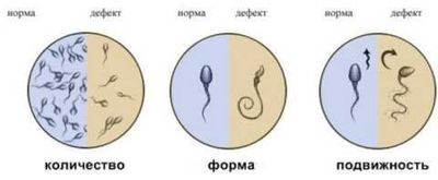 Нормальное и дефектное движение сперматозоидов