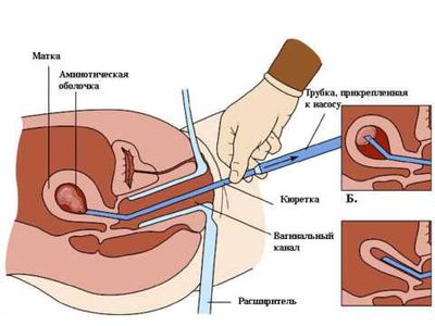 Вакуумный мини-аборт - причина бесплодия