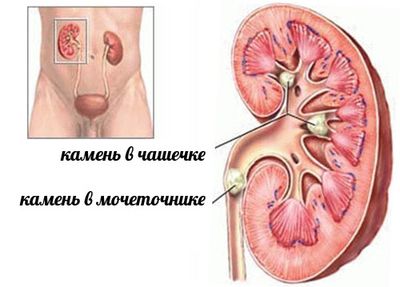 камни в почках и мочеточниках