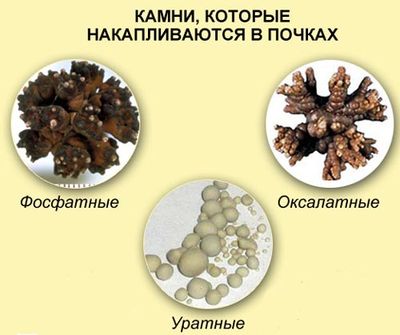 виды камней в почках