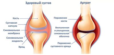 Артрит коленного сустава