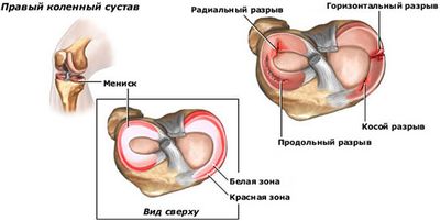 Разрыв мениска коленного сустава