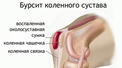 Бурсит в коленном суставе