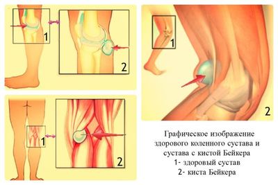 Киста Бейкера