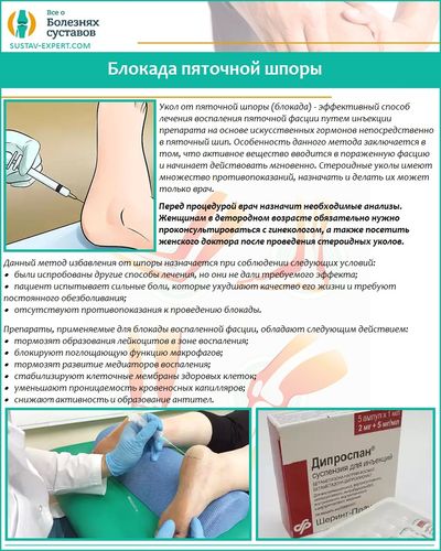 Блокада пяточной шпоры