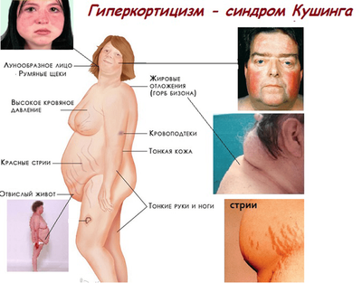 синдром ищенко кушинга