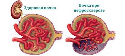 нефросклероз почек