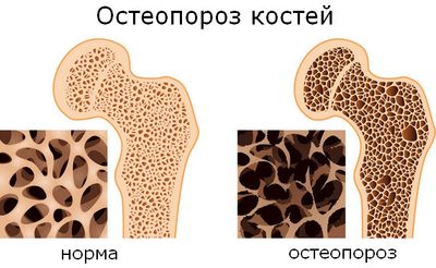 остеопороз при болезни Иценко-Кушинга