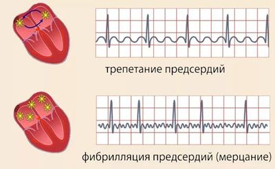 трепетание предсердий