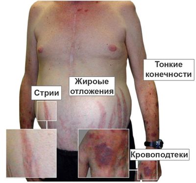 Синдром Иценко - Кушинга у мужчин