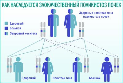 Поликистоз почек у детей: причины