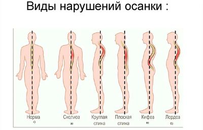 Виды нарушения осанки