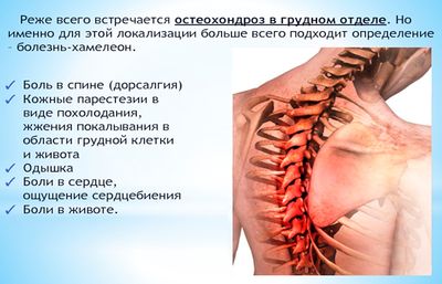 Грудной остеохондроз