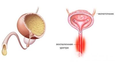 схема уретрита