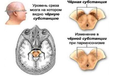 черное вещество при паркинсонизме