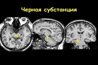 узи черной субстанции