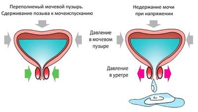 почему выделяется моча при кашле и чихании