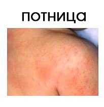 Потница на теле ребенка
