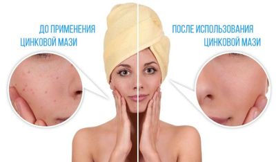 Цинковую мазь наносят на кожу тонким слоем