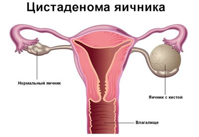 Цистаденома левого яичника