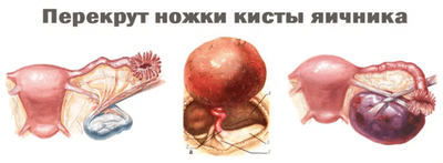 перекрут ножки кисты яичника