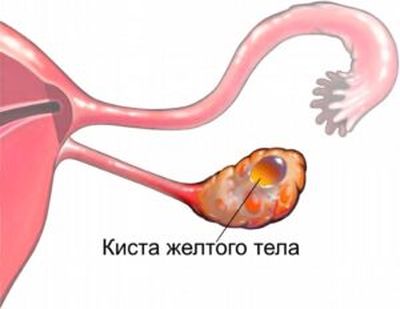 киста желтого тела-1